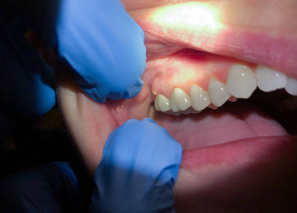 Best Emergency Treatment for Oral Infections in Lockney, TX